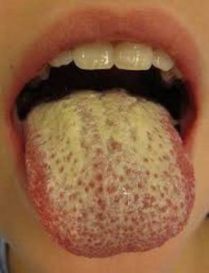 usta jezik kandida-230x300